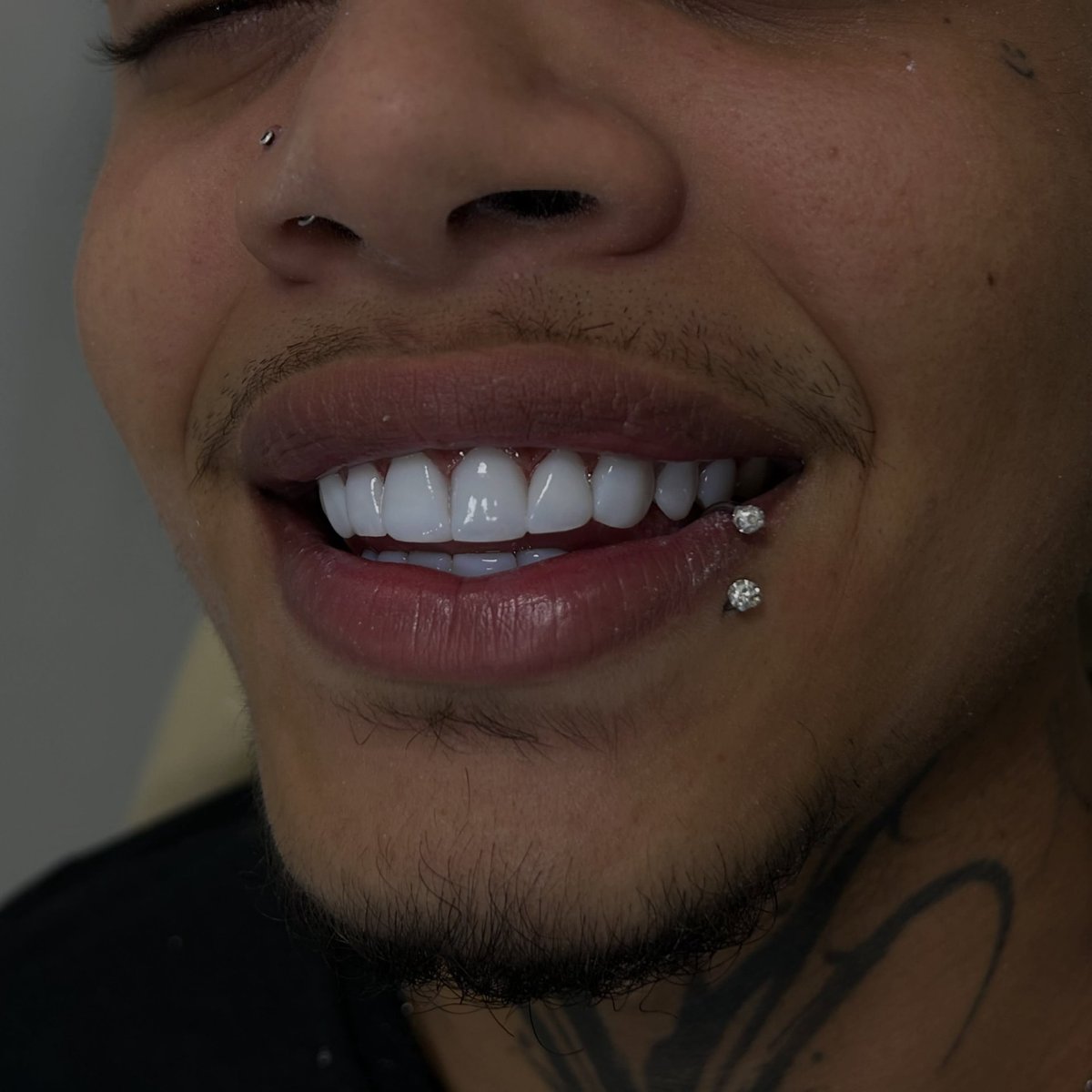 Sorriso com lentes — paciente do Instituto Araújo