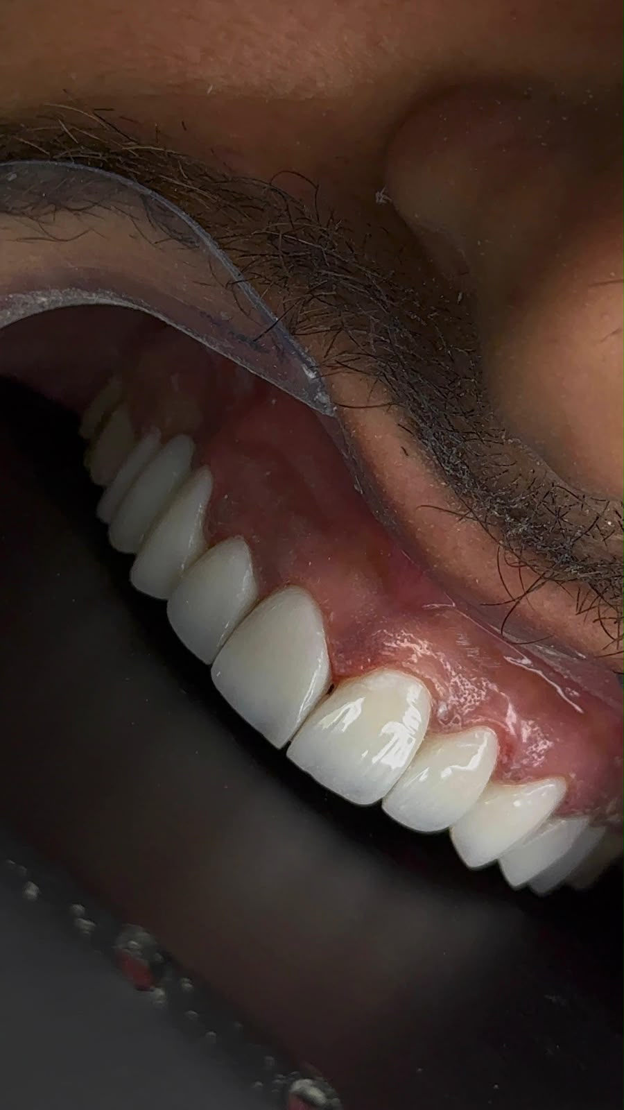 Caso 3 — Harmonização do sorriso — depois